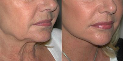 lifting realisé par le docteur philippe Kestemont