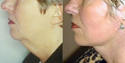 lifting realisé par le docteur philippe Kestemont