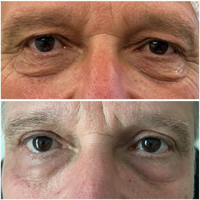 blepharoplastie medicale