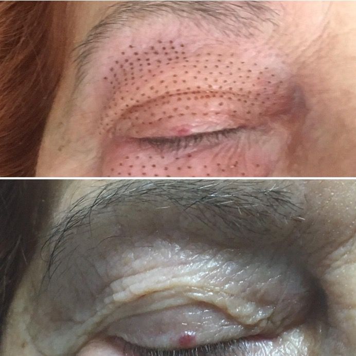 peeling medical