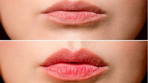 acide hyaluronique bouche