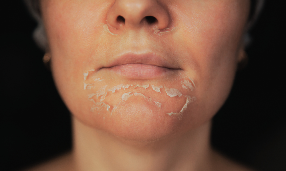 peeling