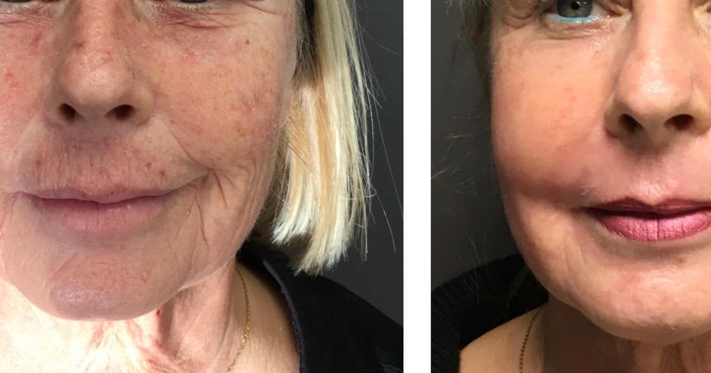 Photo patiente avant et après un peeling au phénol