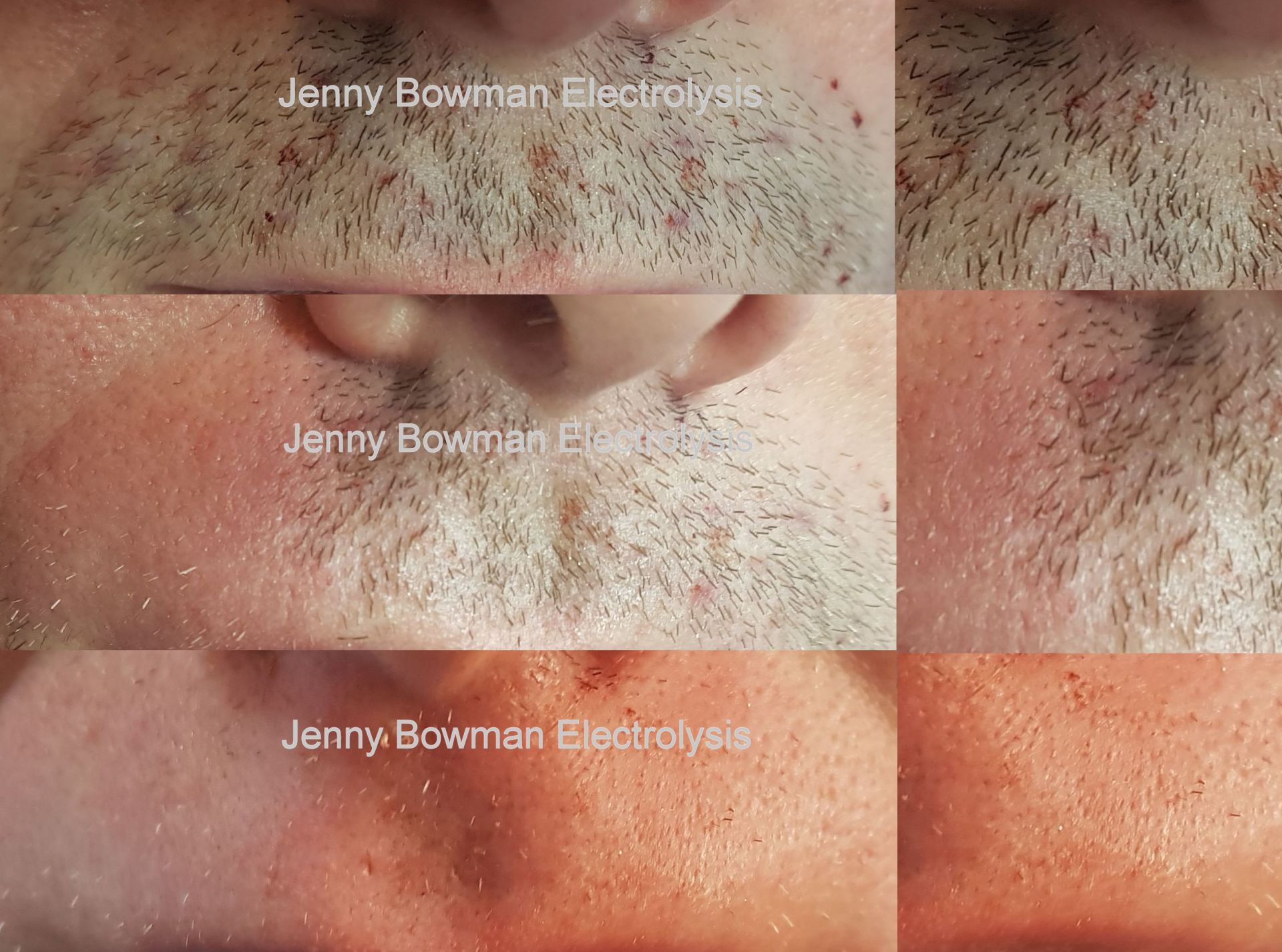 Jenny Bowman electrolysis facial hair removal