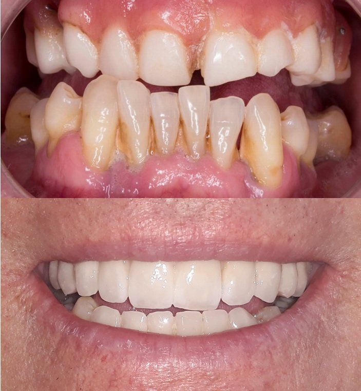 Ortodoncia: Casos Reales. Clínica Dental Cámara. Dentista en Granada. Dentista en Jaén.