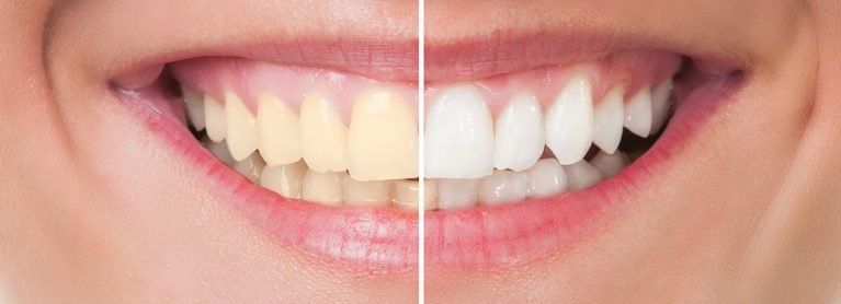 Blanqueamiento dental hoy mismo. Clínica Cámara. Dentista Granada. Dentista Jaén