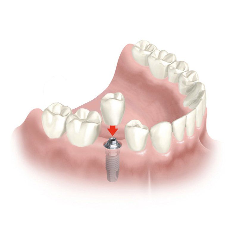 Implante dental unitario. Clínica Dental Cámara. Dentista Granada. Dentista Jaén.