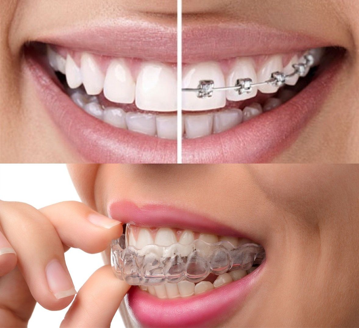 Invisalign: ¿Es realmente invisible?. Clínica Cámara. Dentista en Granada y Jaén.