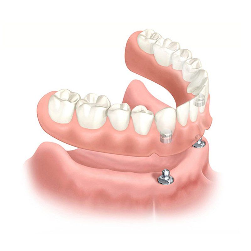 Prótesis completa sobre dos implantes dentales con locators. Clínica Dental Cámara. Dentista Granada. Dentista Jaén.