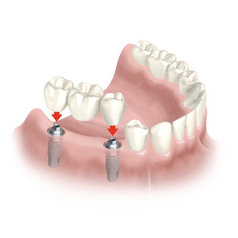 Puente de prótesis fijas sobre implantes dentales. Clínica Dental Cámara. Dentista Granada. Dentista Jaén.