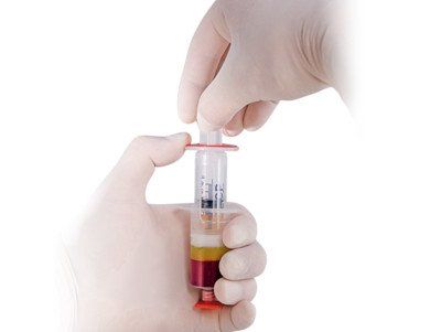 Informationen zu ACP PRP Therapie Arthrose