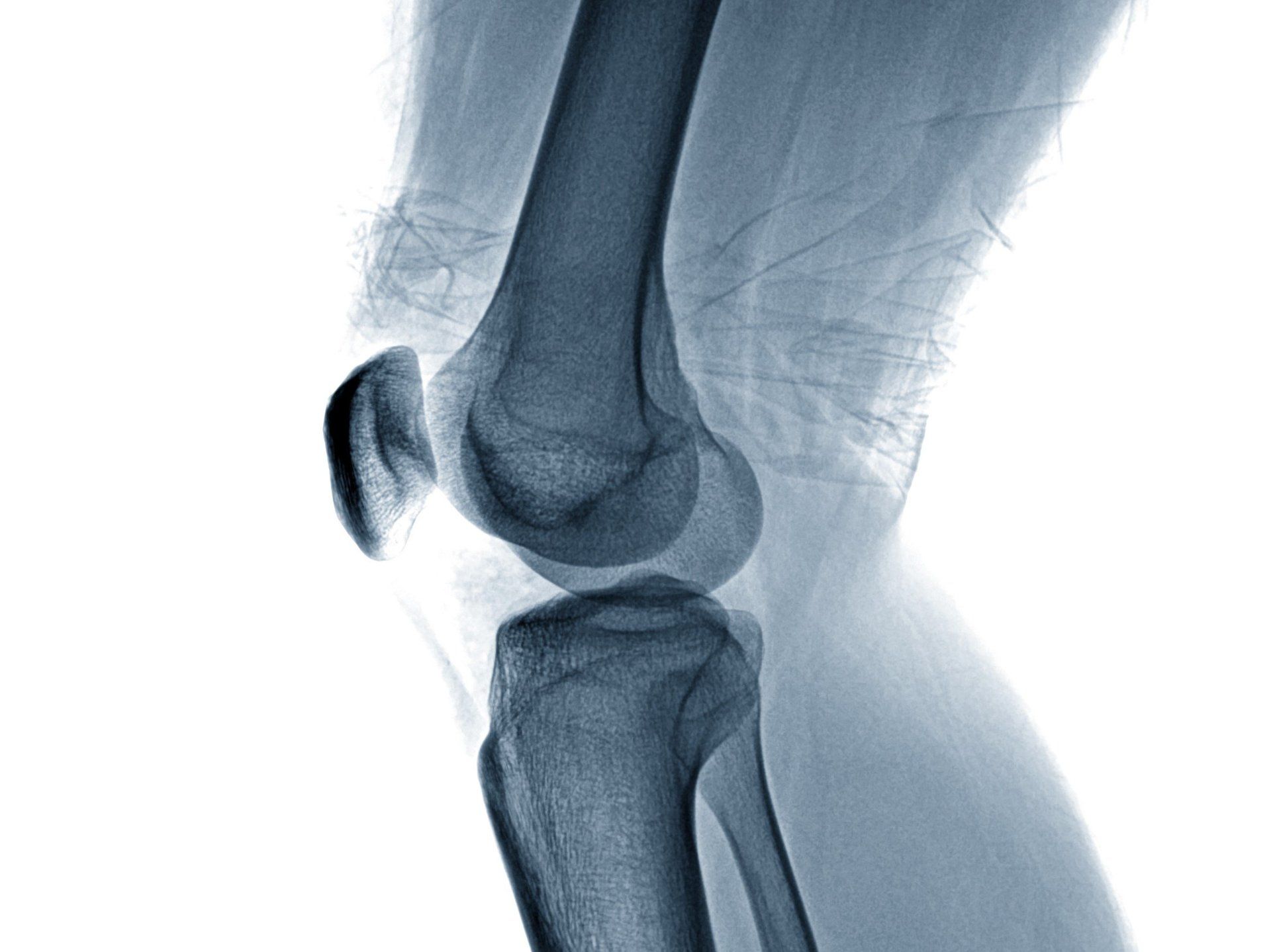 Informationen zu Arthrose und Arthrosebehandlung München