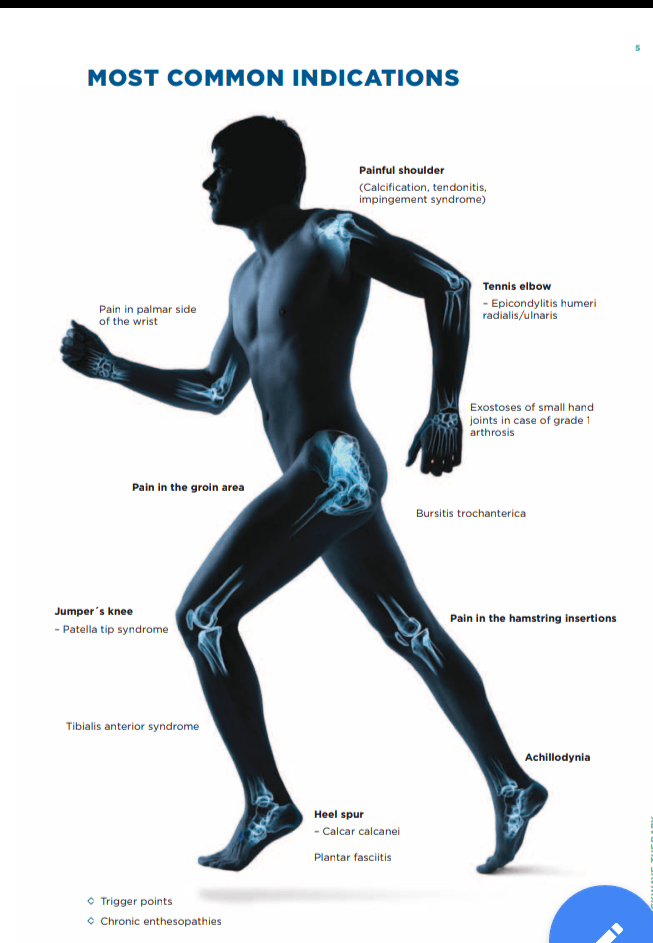 shockwave therapy birmingham