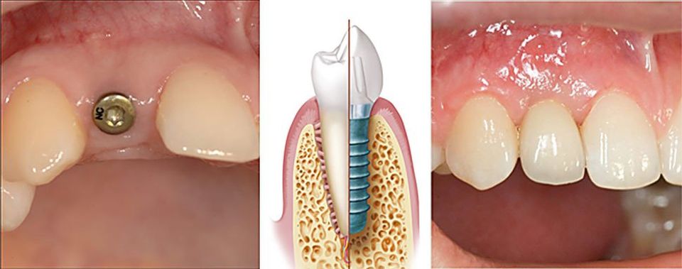 Bildkombination Implantologie mit gesetztem Implantat, schematischer Darstellung und finalem Ergebnis im Keramikkrone