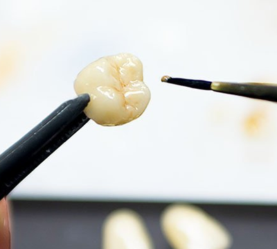 Eine Zahnkrone wird farblich an die Umgebungszähne angepasst