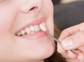 Auswahl de4r richtigen Zahnfarbe für die Herstellung von Veneers