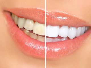 Vorher/Nachher Darstellung der Leistung des Bleaching