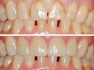 Das können Veneers: Gegenüberstellung vorher/nachher