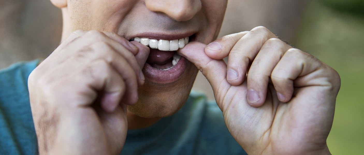 Aligner Erlensee, Aligner Therapie, Unsichtbare Zahnspange, Zahnarzt Erlensee Thim