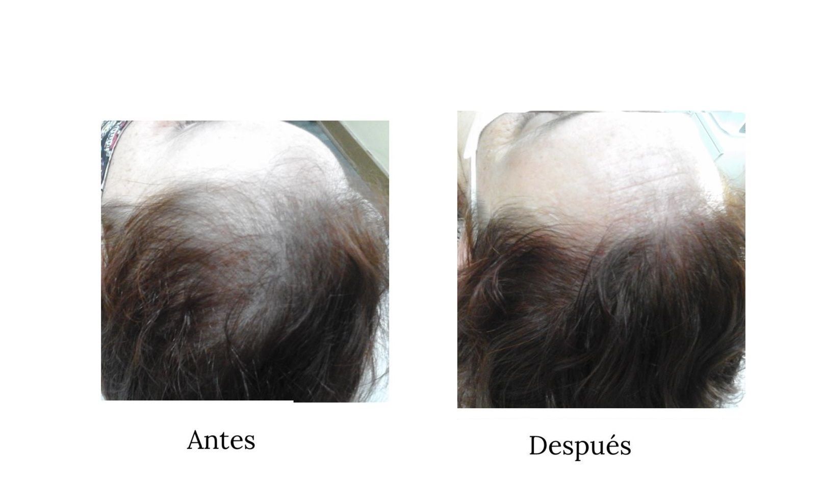 PRP capilar, dutasteride capilar