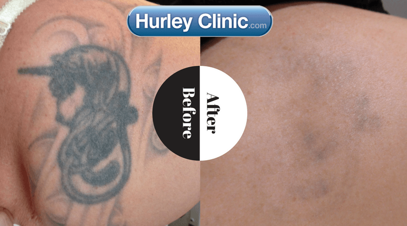 Laser tattoo removal treatment being carried out in clinic