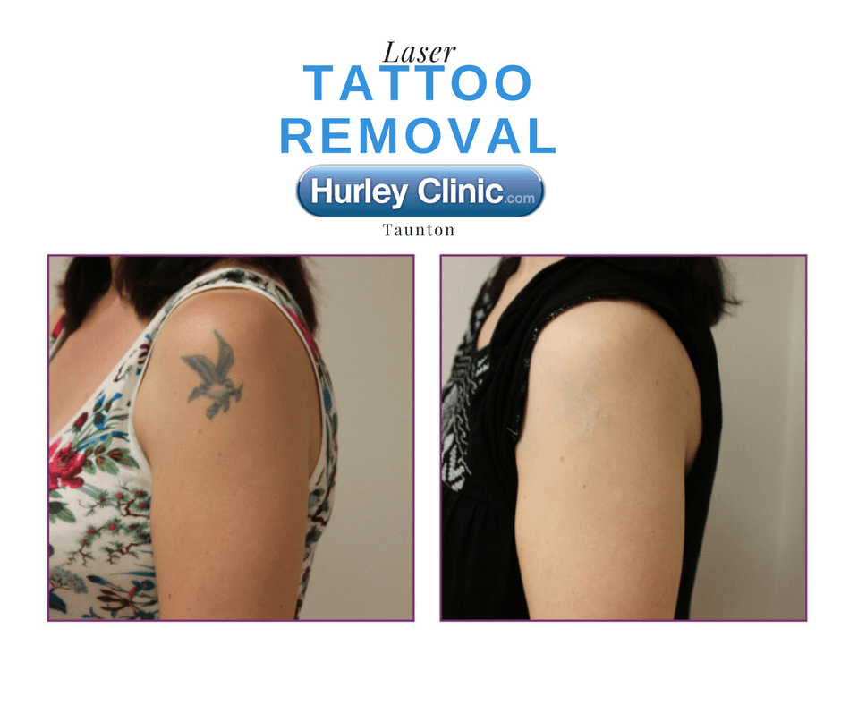 Laser tattoo removal before and after treatment results