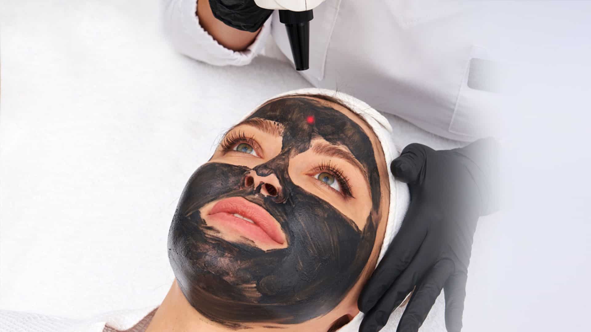 Carbon Peel au Laser