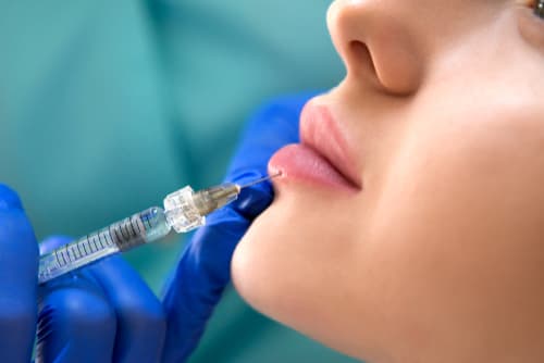 Injection acide hyaluronique dans les lèvres - Centre laser Murano