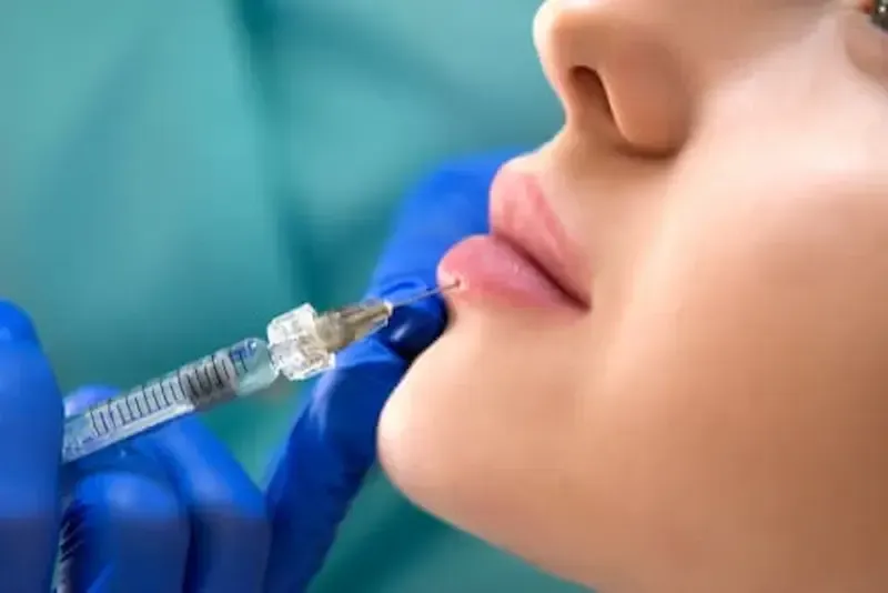 Injection acide hyaluronique dans les lèvres - Centre laser Murano