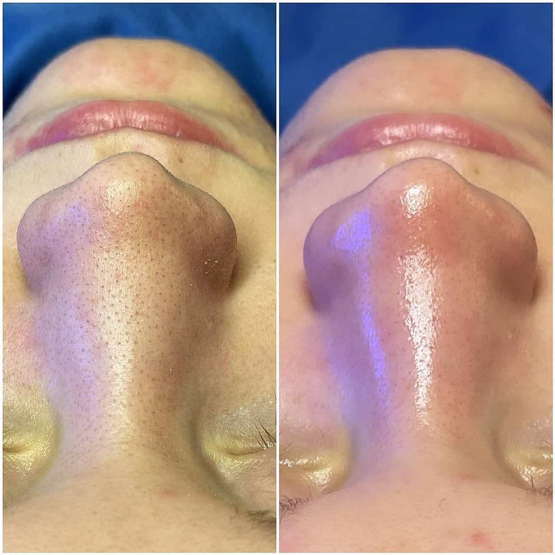Hydrafacial Avant Apres par Centre Laser Murano