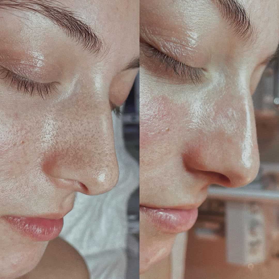 Hydrafacial Avant Apres