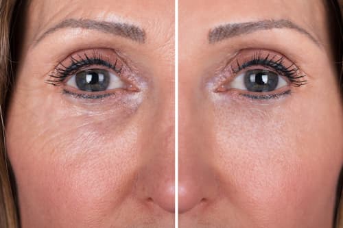 Skinbooster mésothérapie visage au  centre laser Murano