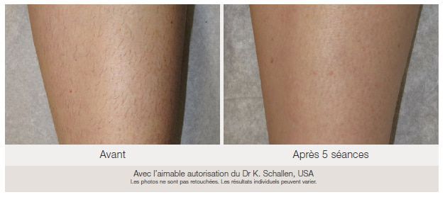 avant_apres_epilation_laser_gentlemaxproplus_murano