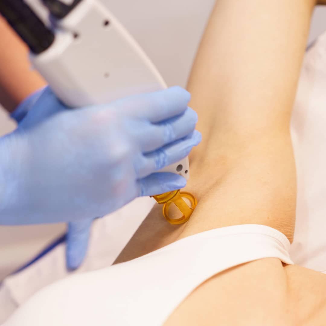 Blog Murano - Epilation Laser Définitive en Septembre a la rentrée