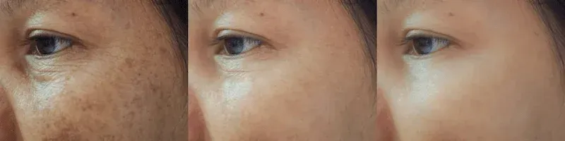 Taches Pigmentaires et Brunes aux Centres Laser Murano