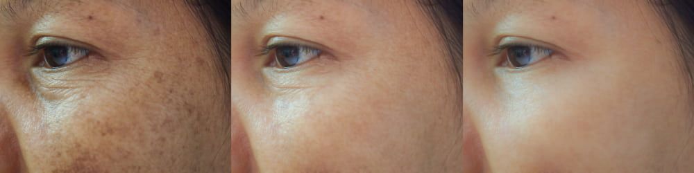 Taches Pigmentaires et Brunes aux Centres Laser Murano