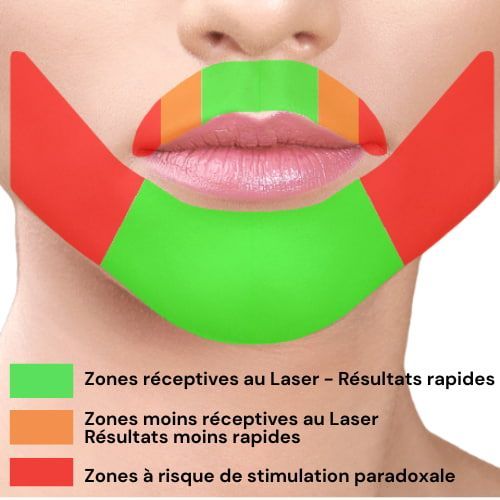 Stimulation paradoxale Visage Electrolyse Centre Laser Murano
