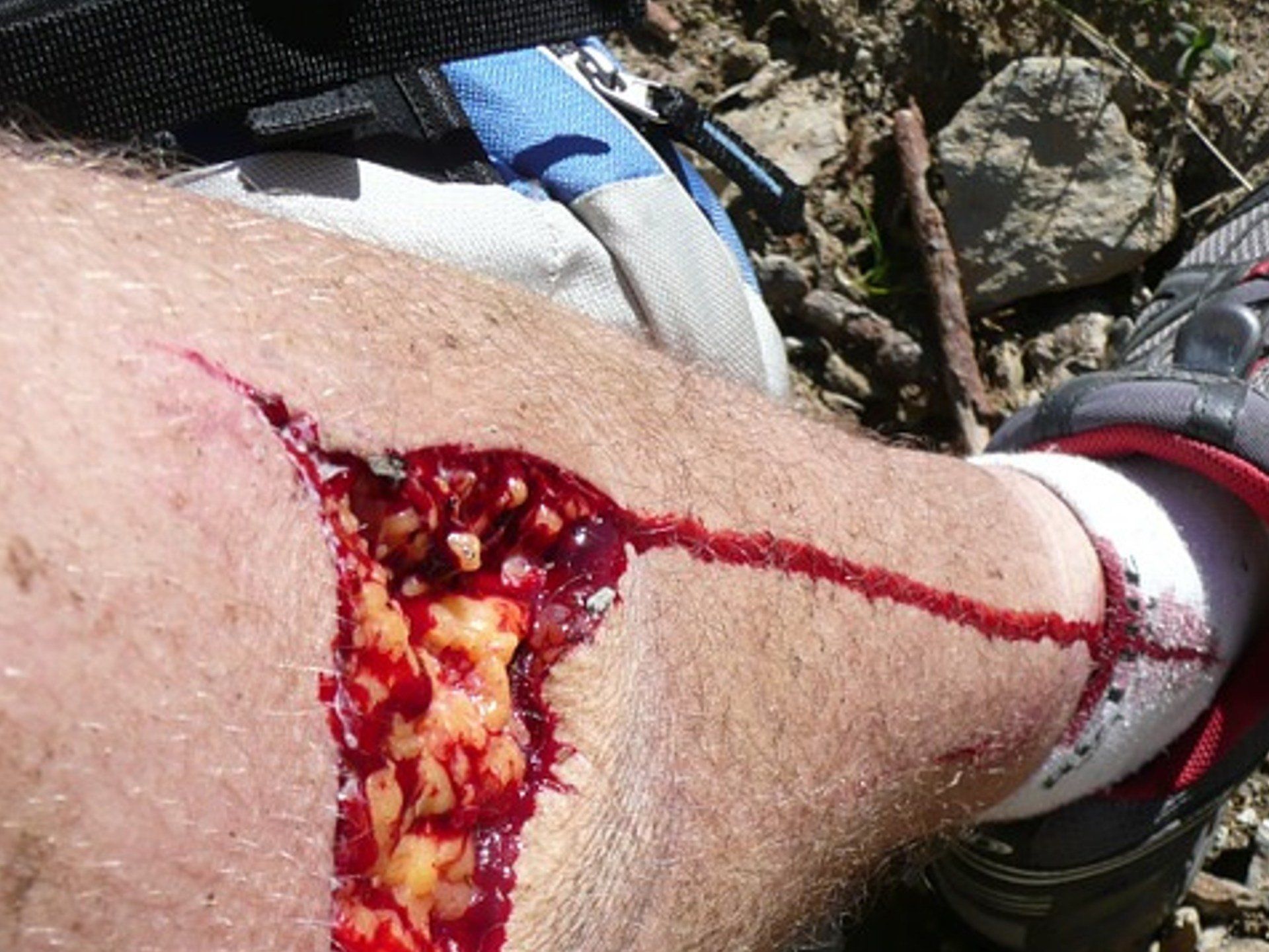 AZÜ.SH Wunde Wandern Erste-Hilfe Selbsthilfe Hiking