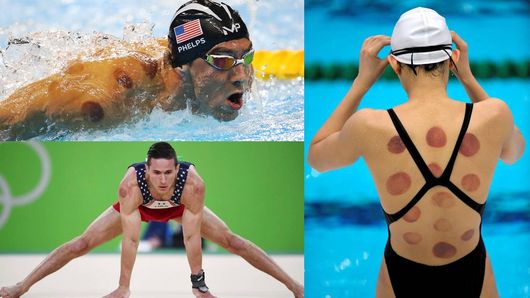 des sportifs de haut niveau ont adopté les ventouses