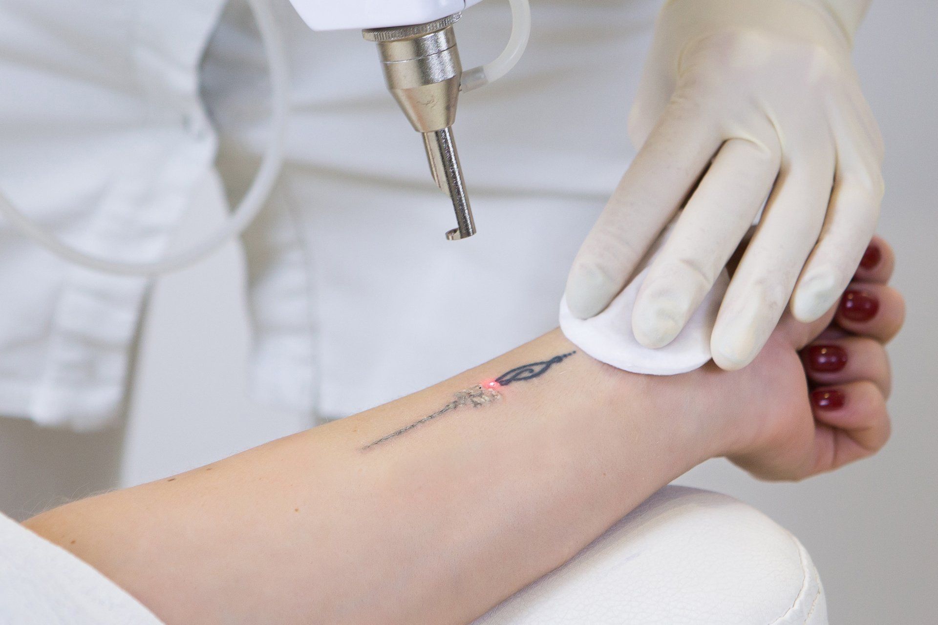 Tattooentfernung Link Ästhetik