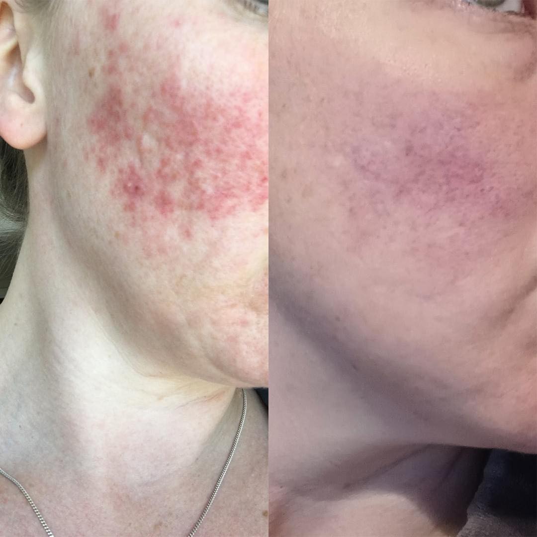 Rosacea Treatment