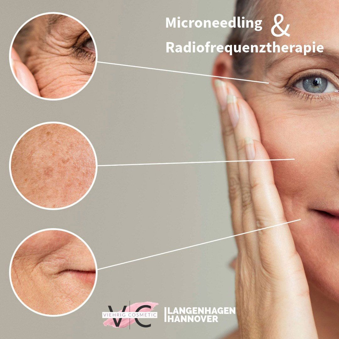 Microneedling Hannover - Langenhagen. Exklusives Angebot