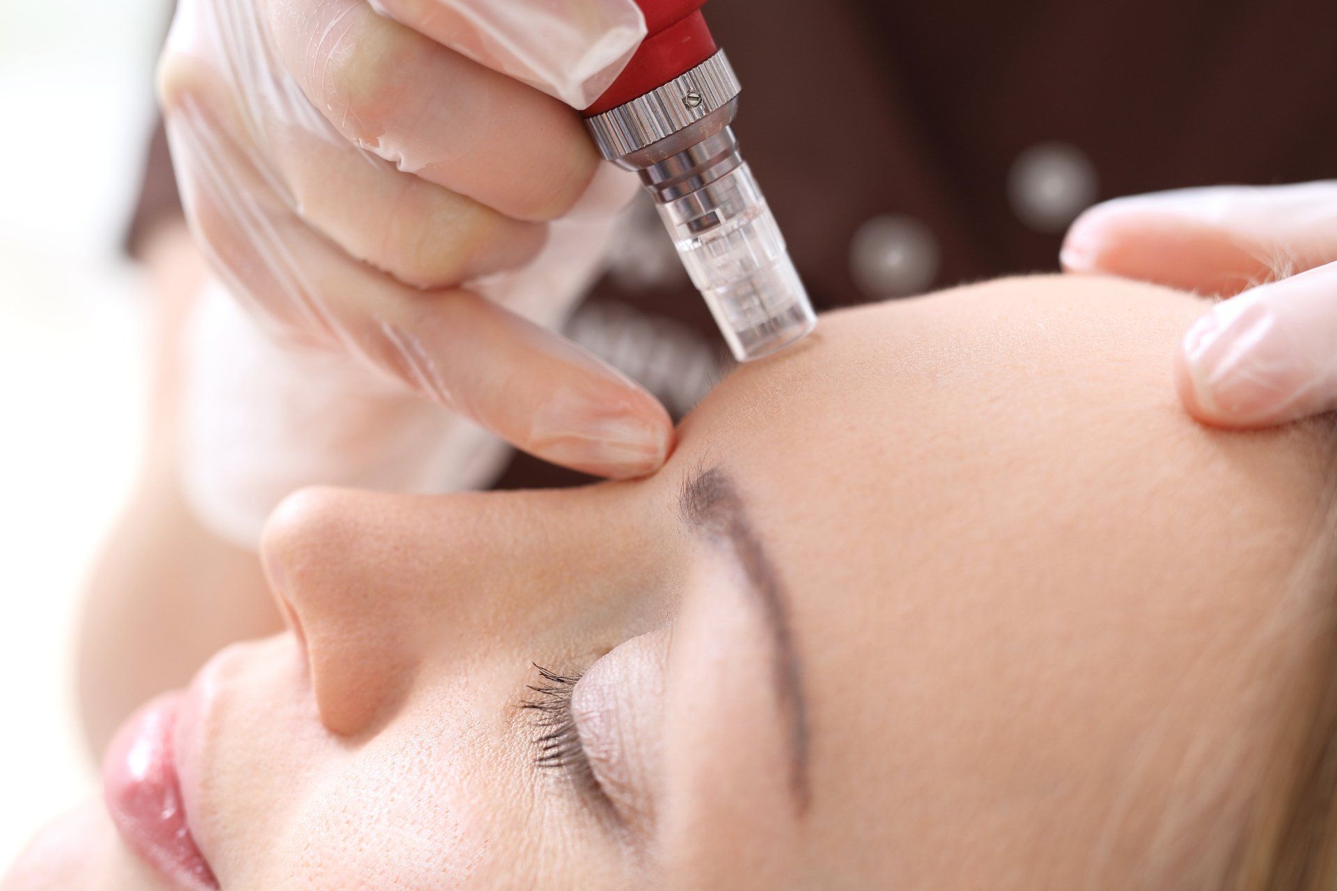 Microneedling Microneedling