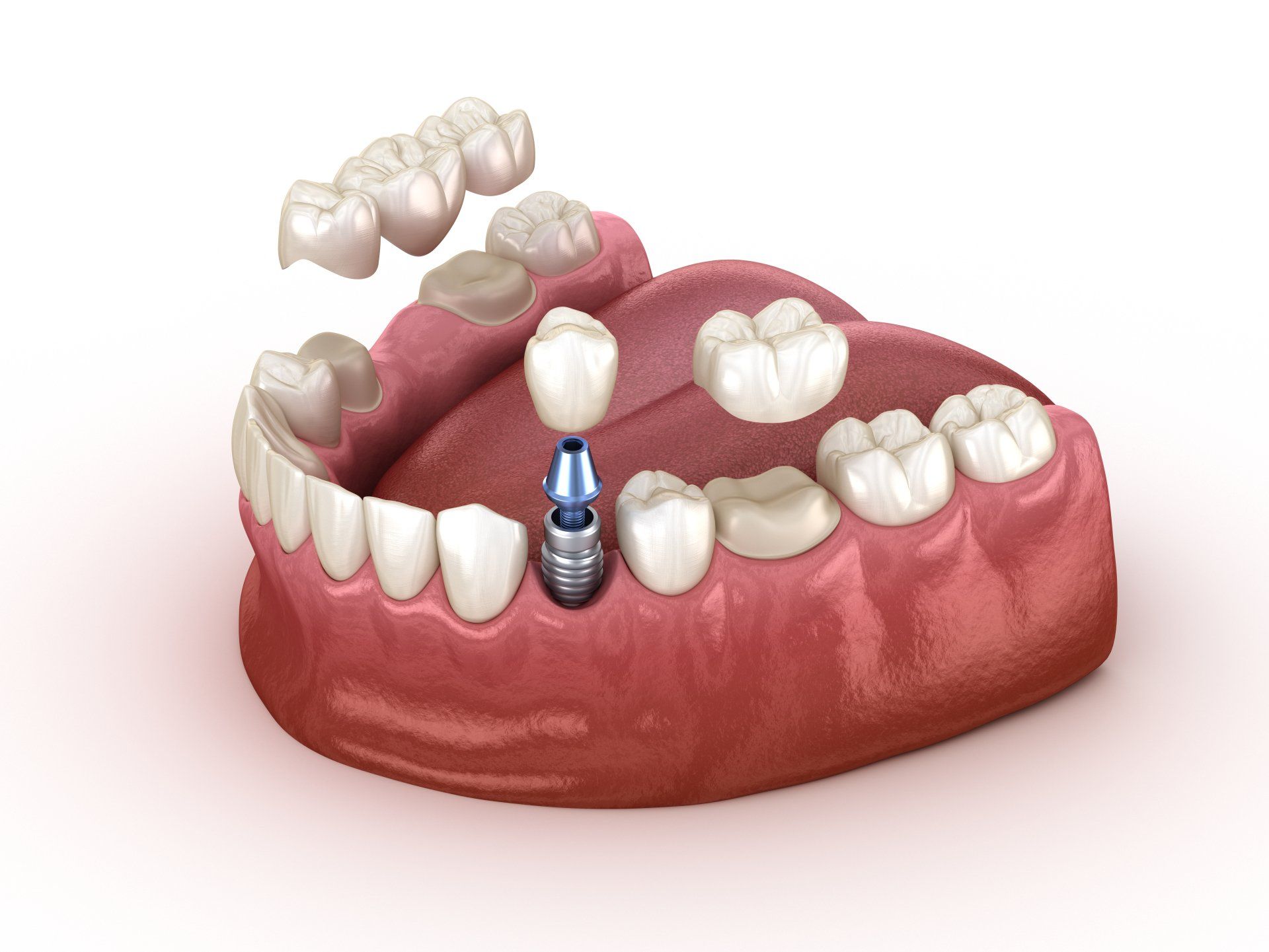 Zahnrückgewinnung mit Implantat und Krone. Medizinisch genaues 3D-Illustrations-Zahnkonzept