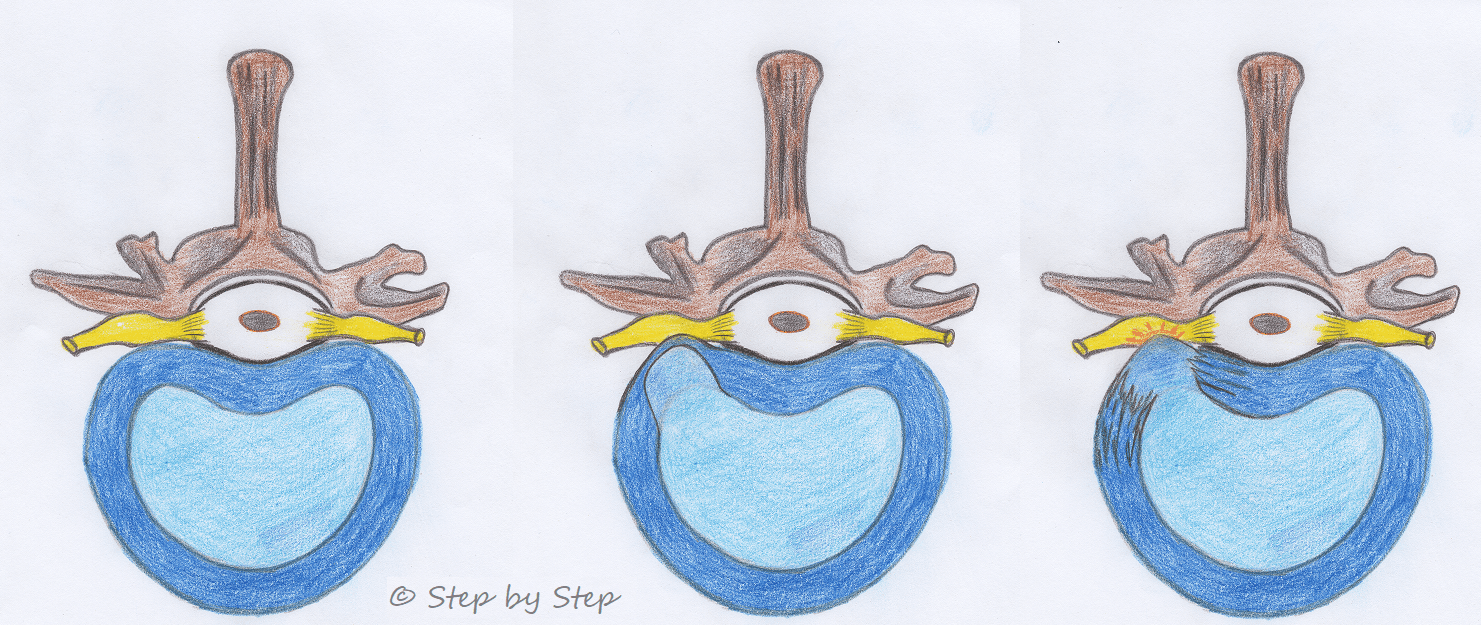 Step by Step - Tierphysiotherapie Hannover Sina Gratzke Kreuzbandriss