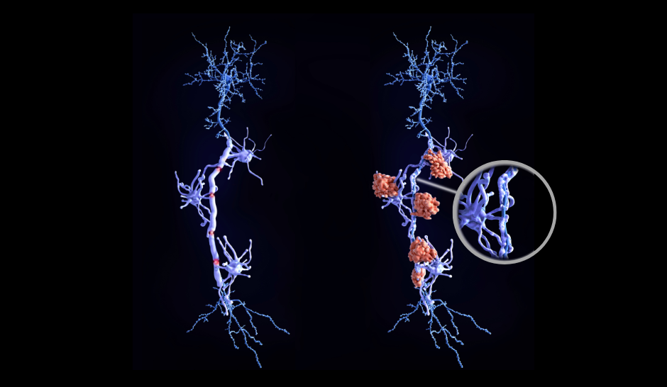 ALS betroffener Nerv
