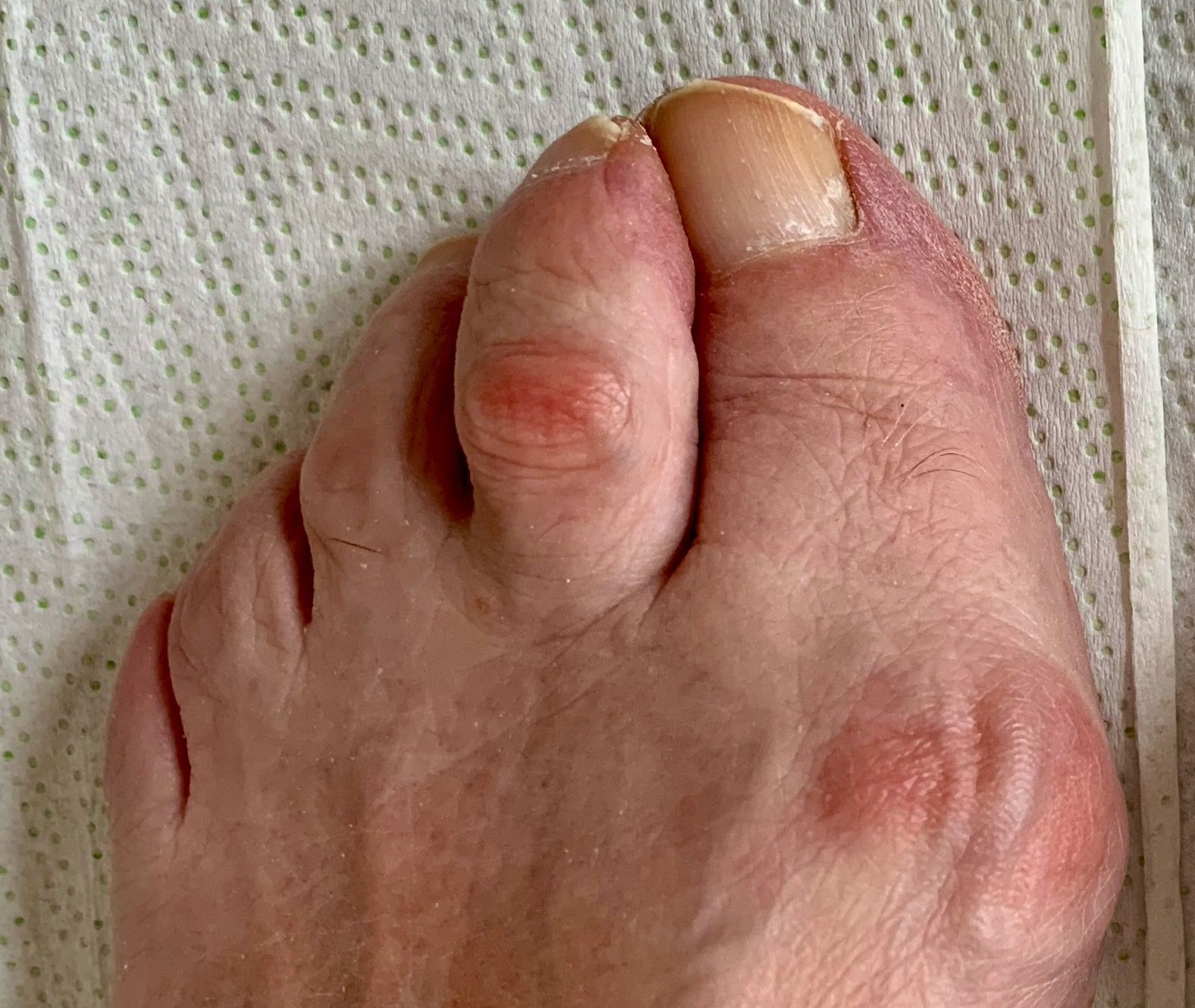 Fuß mit sichtbar verformten zweiten Zeh