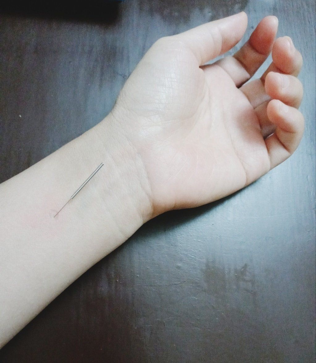 Palpitation from SVT improved with Acupuncture & Herbs