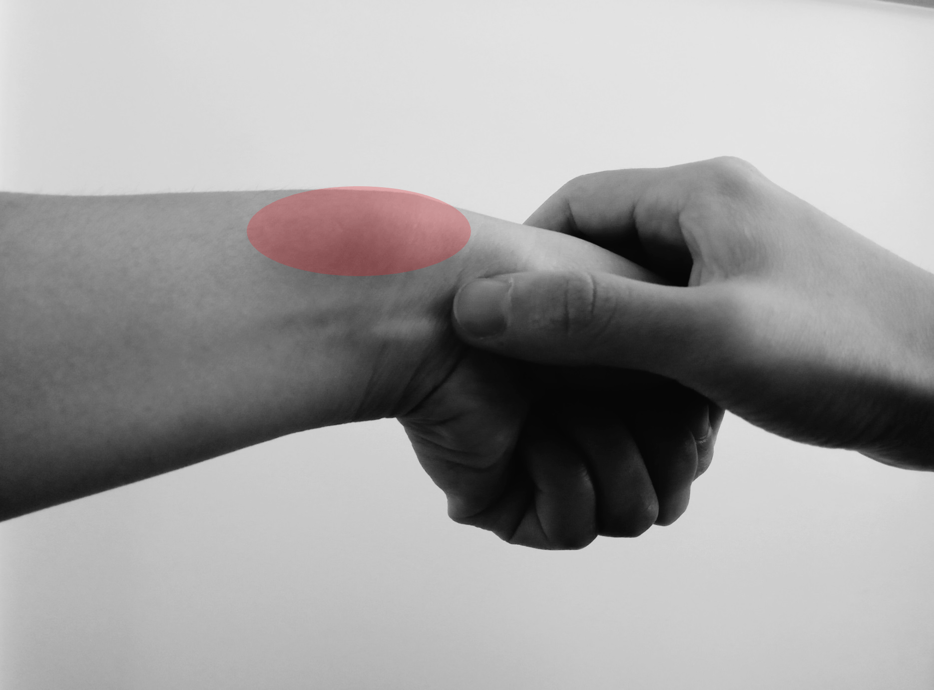 De Quervains Tenosynovitis