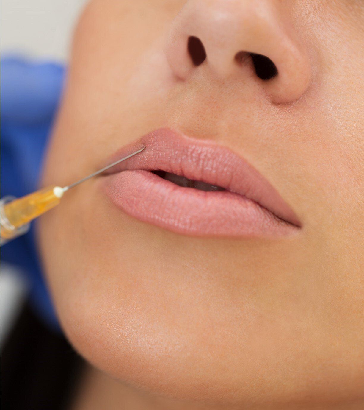 lip fillers Morecambe Lancaster Carnforth Carlisle Morphet